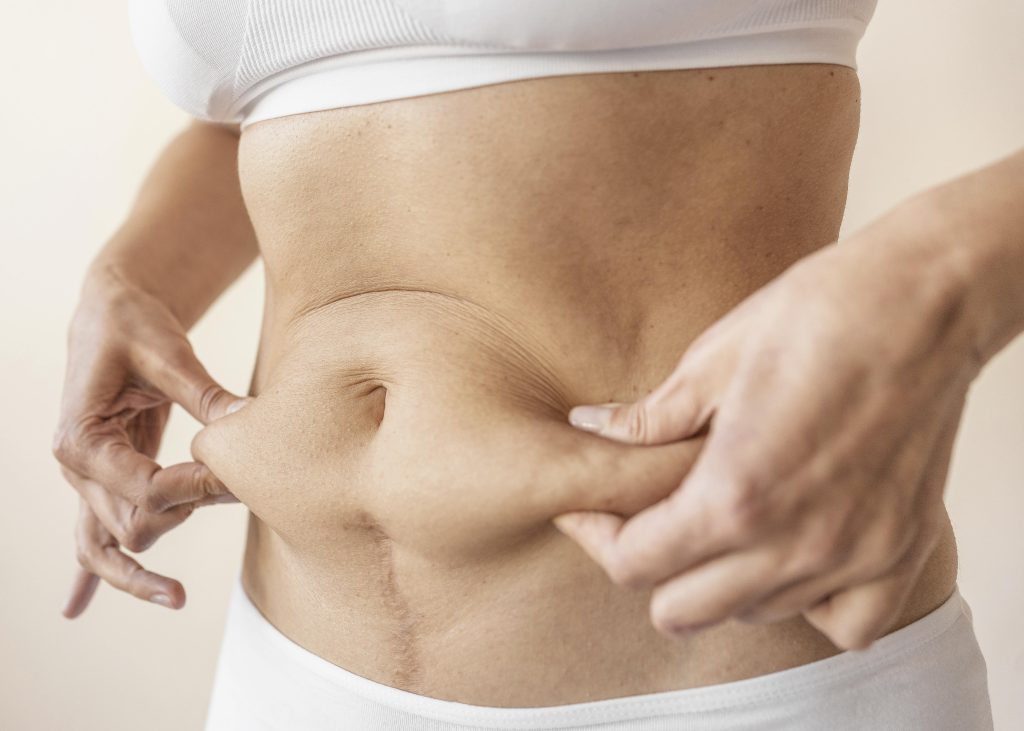 Mommy makeover en Pamplona con el Dr.Fernández Ibarburu